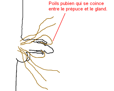 bite avec les poils coincé dans le prépuce